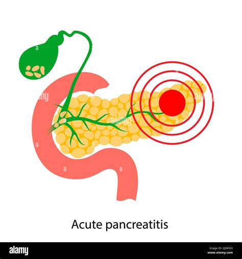Acute Pancreatitis Illustration Stock Photo Alamy
