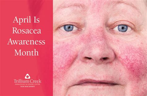 April Is Rosacea Awareness Month Trillium Creek Dermatology