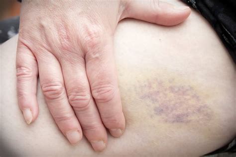 What Are The Causes Of Bruising Easily