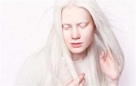 Albinismo Qué Es Causas Síntomas Y Más Canalsalud Sexiz Pix