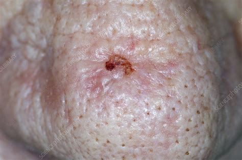 Basal Cell Skin Cancer On The Nose Stock Image C0111783 Science