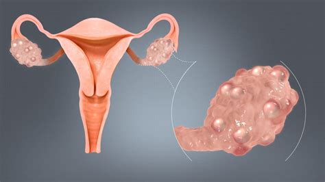 Syndrome des ovaires polykystiques symptômes et traitement