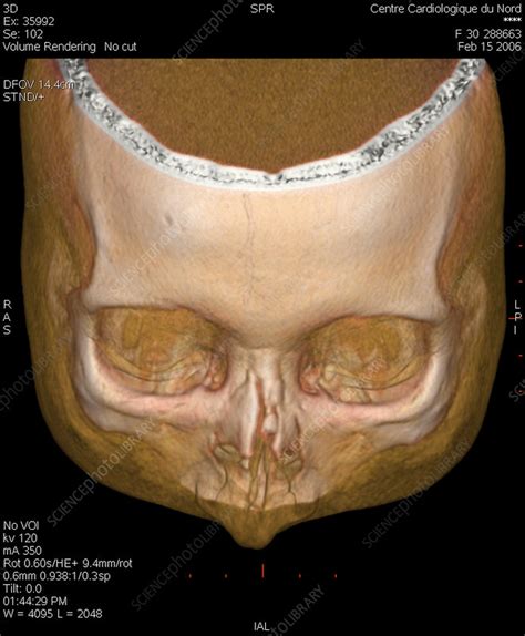 Fractured Nose 3d Scan Stock Image C0040820 Science Photo Library