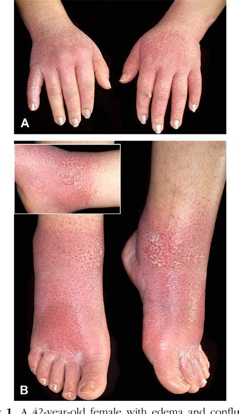 Figure 1 From Bullous Papular Purpuric Gloves And Socks Syndrome In A