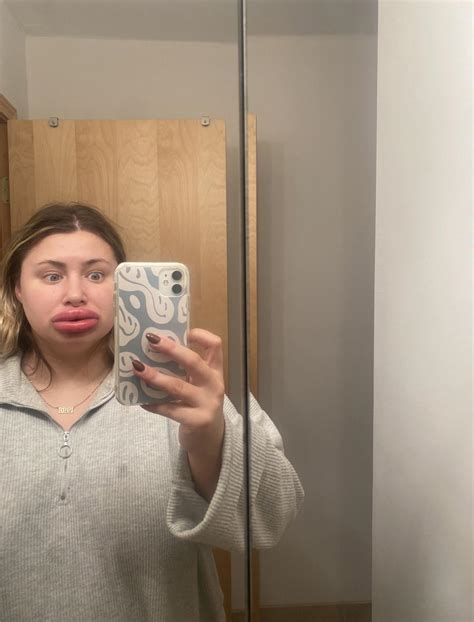 Woman Claims Botched Fillers Left Her With Monsters Inc Lips