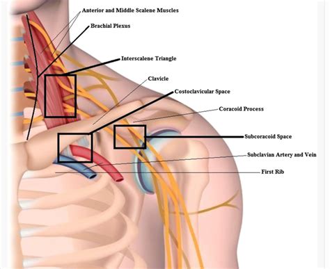Vascular Thoracic Outlet Syndrome — The Sports Medicine Review