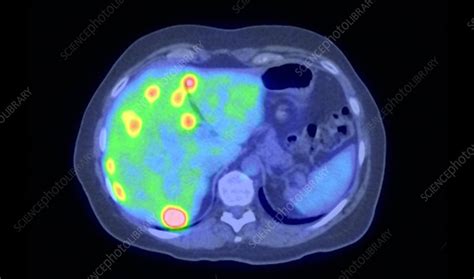 Secondary Liver Cancer Ct And Pet Scans Stock Image C0017975