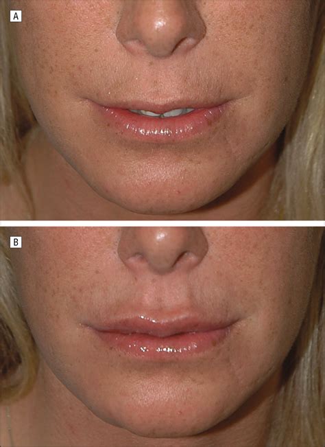 Although cupid is portrayed with a bow and arrow, most people don't know that he actually had two arrows or perhaps one arrow with two very different tips. A New Classification of Lip Zones to Customize Injectable ...