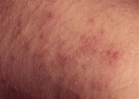 How Do I Treat An Epstein Barr Rash With Pictures