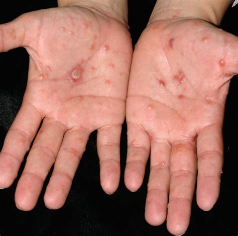 Sintético 94 Imagen De Fondo Fotos De Dermatitis En Las Manos Cena Hermosa