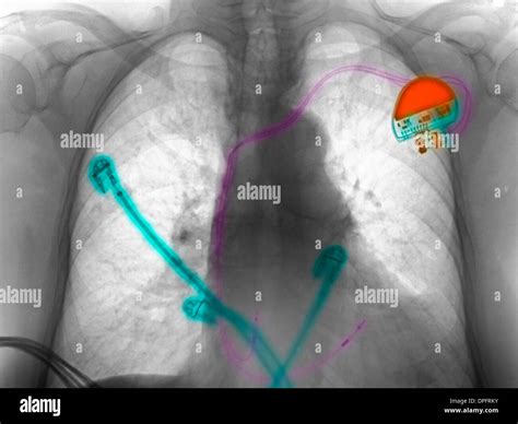 Chest X Ray Of A Pacemaker Stock Photo Alamy