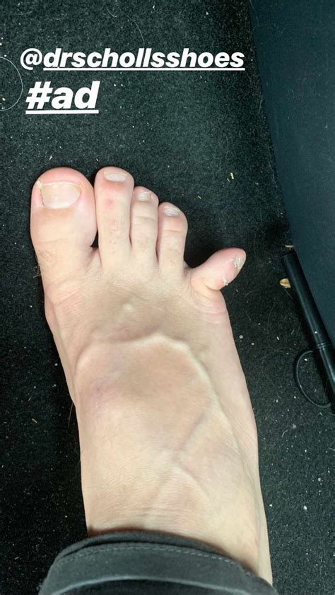 This Dudes Broken Toe Is So Gross—but His Wife Made It Hilarious