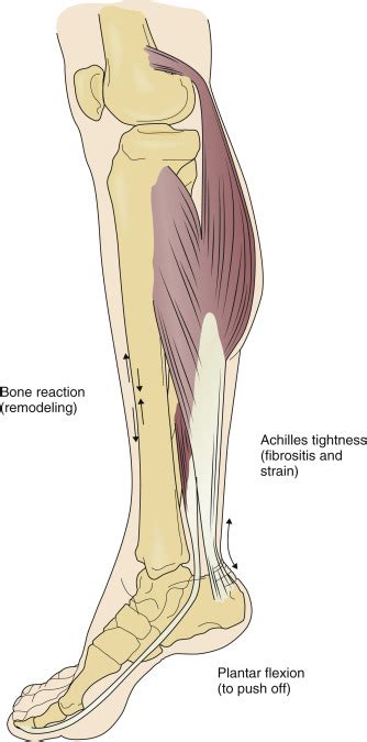 Shin Splints | Musculoskeletal Key