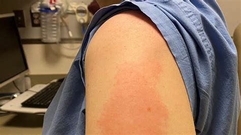 Covid Study Moderna Arm Vaccine Rash No Worse With Second Shot