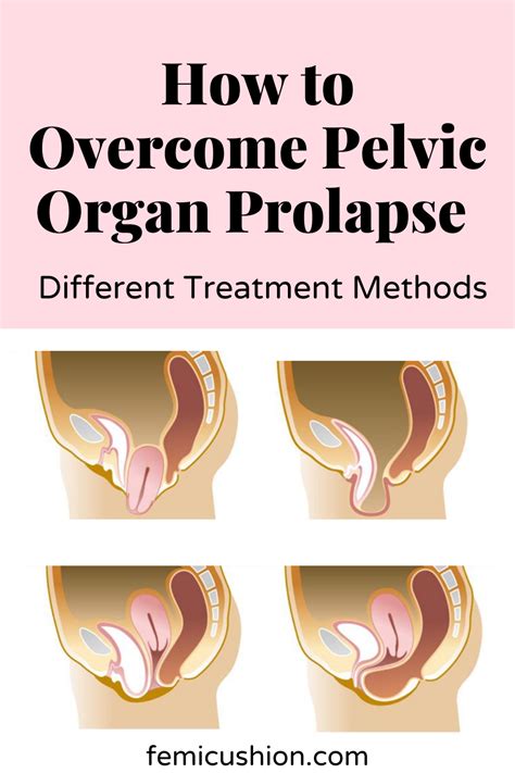 Treatment For Pelvic Organ Prolapse Bladder Prolapse Prolapsed Uterus