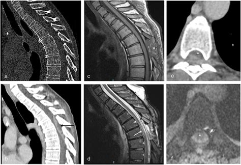 Sagittal And Axial Ct And Mri Images Illustrating Patient No 4 Ab