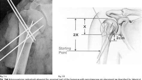 Figure 2 From Literature Management Of Proximal Humeral Fractures Based