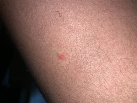 Any Ideas What These Bumps Could Be Dermatology Forums Patient