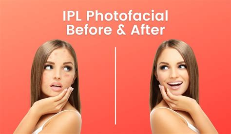 Ipl Photofacial Before And After Results Lumenessa Lumenessa