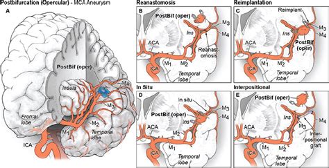 Bypass Surgery For Complex Middle Cerebral Artery Aneurysms An