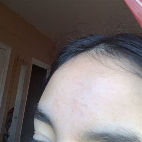 Forehead Bumps General Acne Discussion Acne Org