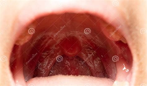 Sore Throat With Throat Swollen Closeup Open Mouth With Posterior