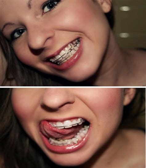 girl wearing retainers braces braceface girlswithbraces retainers cute braces colors