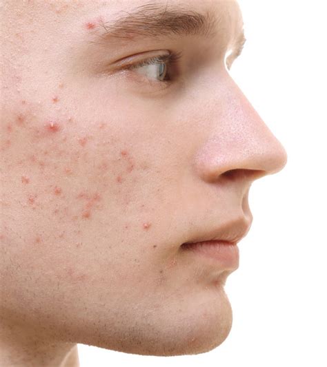 Acne Clinical Research Studies In Tampa Bay And Brandon Fl