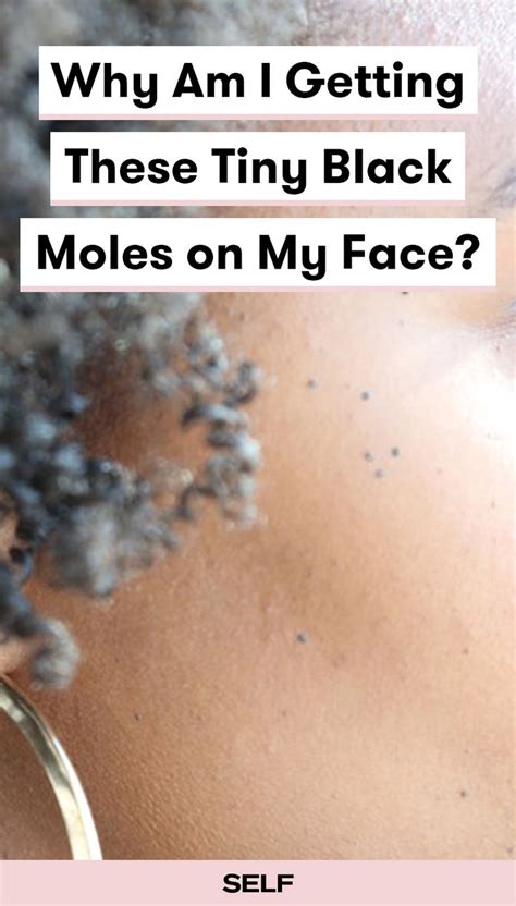 When to call the doctor. Why Am I Getting These Tiny Black Moles on My Face ...