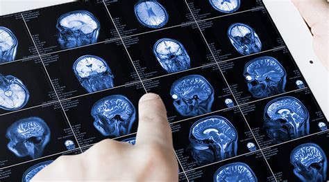 Understanding Signs And Symptoms Of Brain Tumors Insight Neurosurgery