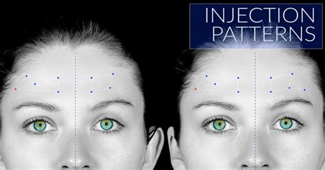 Best Tried And Tested Botox Injection Patterns Dr Tim Pearce
