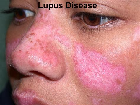 Lupus Disease Signs And Symptoms Diagnosis And Treatment