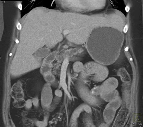 Sarcoidosis Of The Spleen As Well As Dilated Pancreatic Duct Spleen