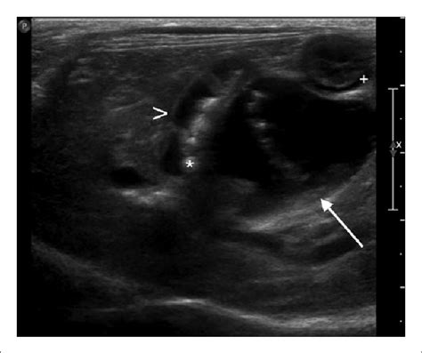Transverse Sonogram Of The Segmental Common Bile Duct Cbd Dilatation