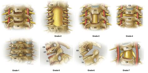 Cervical Pedicle Subtraction Osteotomy For Correction Of Sagittal