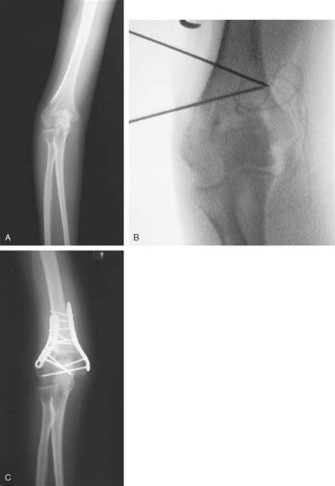 Nonunion And Malunion Of Distal Humerus Fractures Musculoskeletal Key