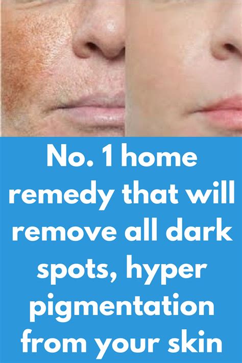 No 1 Home Remedy That Will Remove All Dark Spots Hyper Pigmentation