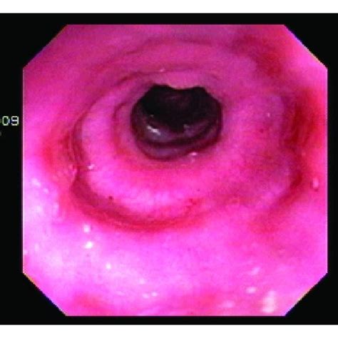 Biopsy Revealing Eosinophils In The Esophagus Download Scientific