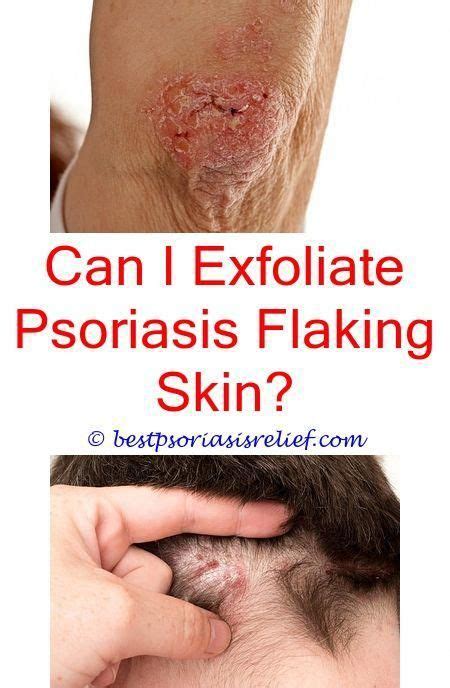 Guttate Psoriasis Scars