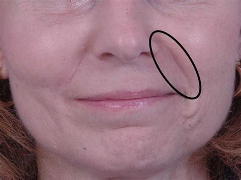 A dark horizontal line on nose is typically due to allergies. Nasolabial folds: Causes, treatment, exercises, and prevention
