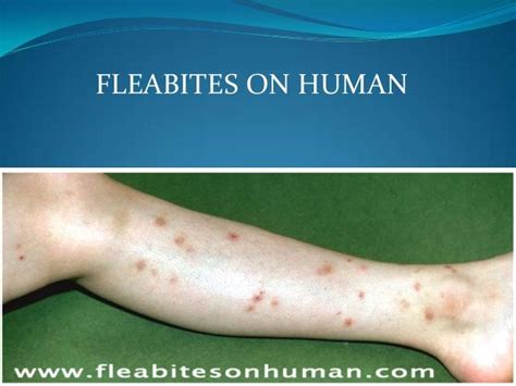 Flea Bites On Human Pictures Photos