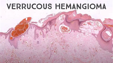 Verrucous Hemangioma Pathology Dermpath Dermatology Dermatopathology