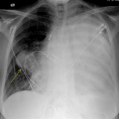 Pa Chest Radiograph 2021 Near Complete Opacification Of The Left