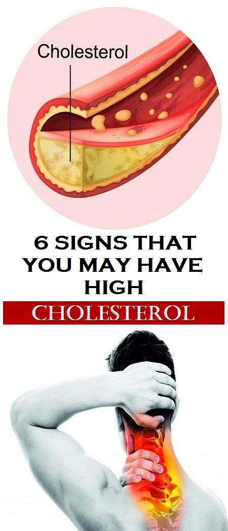 6 Signs That You May Have High Cholesterol With Images High