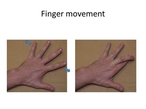 Ulnar Neuropathy At The Elbow Cubital Tunnel Syndrome Neuromuscular