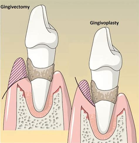 What Is The Difference Between Gingivectomy And Gingivoplasty News