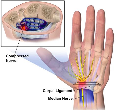Digital Flexion Contracture And Severe Carpal Tunnel Syndrome Due To