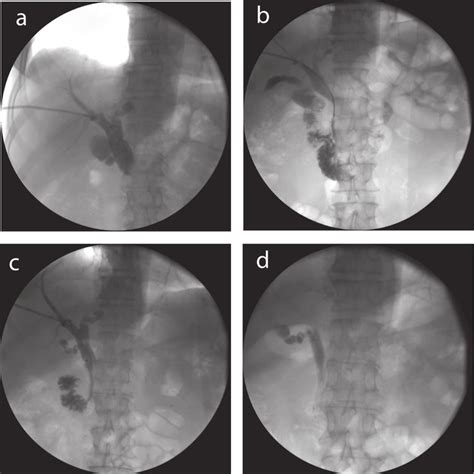 Pdf Percutaneous Biliary Stent Placement In Palliation Of Malignant