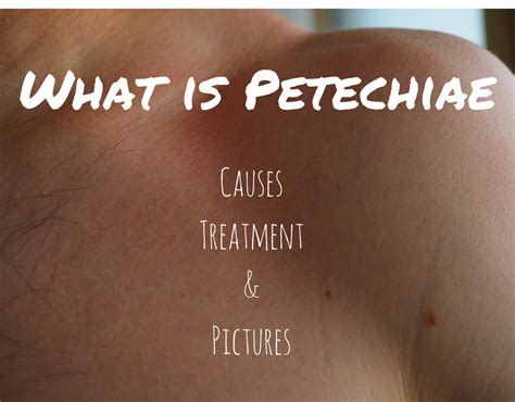 What Is Petechial Hemorrhage Petechiae Rashes With Pictures