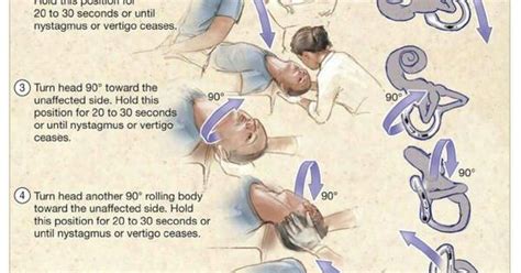 Epley Maneuver For Vertigo With Diagram Showing Whats Happening In The